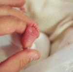 Tratamiento en la Apnea en el prematuro
