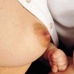 Medidas en el absceso mamario subareolar